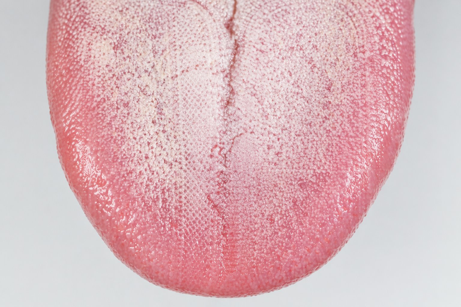 Close-up of tongue coating showing bacteria buildup before using tongue scraper